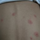 수두(Chicken pox) 이미지