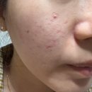 올리브한의원 | 내돈내산 수원한의원 여드름 패인 흉터 치료 새살침, 차침 결치료 5회차 후기