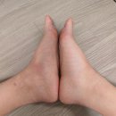여수마디정형외과의원 | [부주상골증후군] 갑자기 아프다. 보행시 절뚝거림.(feat. 의정부 서울마디정형외과의원)