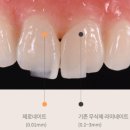 가비세라믹 | 제로네이트 무삭제 라미네이트 비용 가격 부작용 후기 총정리!