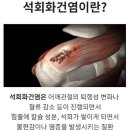 뼈와 건강 세마나 - 칼슘과 석회화 이석증 . 메니에르 증후군 이미지