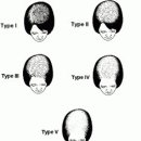 손쉬운 자연요법: 탈모 (Baldness and Hair loss) 이미지