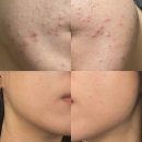 소화의원 | 양준상의원 제균 치료 후기(2)-여드름 치료, 모낭염 치료, 복부팽만, 소화불량, 과민성 대장 증후군...