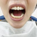 방배역 치과 잇몸치료 전후 자연치아 살리기 후기