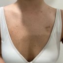 목은빌딩 뒤 | 인천 편평사마귀 성지 이삭가정의학과 1253개 제거후기