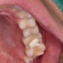 윈 치과기공소 | 신경치료하는중인데 계속 아파요, 빼야한데요. 어디 제가 한번...?