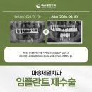마송치과 임플란트 재수술, 실패 원인부터 치료까지