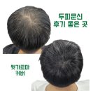 달팽이이비인후과 | 울산 비염수술 한달 후기, 하나이비인후과 레이저수술