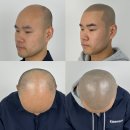 재현카크리닉 | 두피문신: 인천, 김포, 송도, 부천 등에서 인기 있는 두피문신 시술