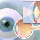 [봄의약속안과]인공수정체(IOL/intraocular lens)란 무엇입니까?(강동구 백내장,백내장수술) 이미지