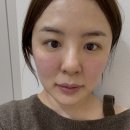 이룸디자인스킨동탄타임 | 내돈내산, 동탄 피부과 온다, 스킨보톡스 후기