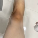 [무릎 착색크림] 숨기고 싶던 거뭇한 색소침착, 트라넥삼산 크림 한 달 사용 후기