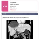 hydatid cyst 이미지