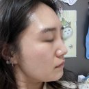 엑쎄라피 써클샷 3주차 이용후기 스트롱모드 비포에프터