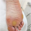 레푸스 호매실점 | 수원 권선동 발각질 제거 진짜 잘하는 곳 레푸스 호매실점