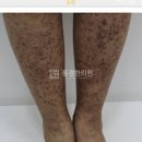 소아 성인 자반증 증상 및 (다리, 피부 붉은반점 혈관염) 이미지