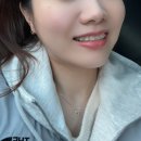 광주아트치과기공소 | 광주교정치과추천 30대 치아교정 후기 17번째 교정일기 (전후사진o)