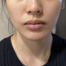 중계역 피부관리 수디끌스킨 물방울리프팅 후기