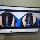 얼라이브피부과의원 | [강남역 탈모병원] 20대 여성 탈모 극복기 with 내돈내산 탈모치료제, 탈모샴푸, 탈모병원