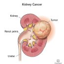 신우암[renal pelvic cancer] 이미지