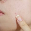 티바이오젠 | 트러블 스팟패치 추천 이마트 노브랜드 트러블 뾰루지 진정 관리