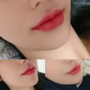 톡스앤필의원불당점 | 천안 톡스앤필 불당점 입꼬리 입술 필러 시술 후기