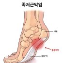 달리기부상 - 족저 근막염 이미지