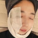 얼굴 흉터 레이저 4회차 후기 | 점점 옅어지는 변화 기록