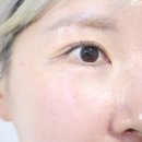 세븐일레븐 광주상무2지구점 | 광주 상무지구 피부과 주근깨 레이저 피토코닝 1회차 솔직후기