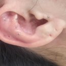 이혈(귀) 상담과 건강관리 이미지