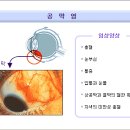 공막염 이미지