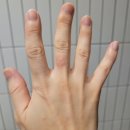 힐더스킨 | 모유수유 중 주부습진 집에서 치료한 방법(피부과 습진연고 비교 후기)