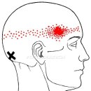 근육학(MPS) 관련 그림 &amp; 동영상 : 두반극근(Semispinalis Capitis) 발통점(Trigger Points) 이미지