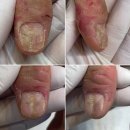 대신 | 한남동 네일샵, 교조증 치료 대신 완벽 해결 후기