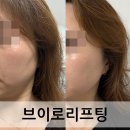 강남피부과 가성비 울써마지 브이로리프팅후기