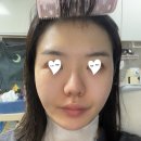 김포이씨씨 | [구월동 피부과] 리쥬란2cc 솔직후기 + 일주일 경과 효과