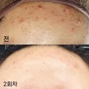 압구정리더스피부과의원 | 압구정로데오피부과 주앤의원:성인 여드름 치료 후기 2번째 방문(이마 집중 공략)