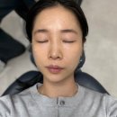 시너지성형외과의원 | 신사성형외과 프락셀 스킨부스터&amp;도로시물광주사 효과 가격 통증