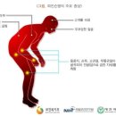 4대 퇴행성 희귀질환 진단비 특별약관[파킨슨병, 알츠하이머병, 근위 축성 측삭경화증(루게릭병), 전신형 중증근무력증] 이미지