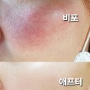 착한피부과 | 얼굴 홍조 치료 병원 피부과 레이저 후기 + 효과 높이는 꿀팁