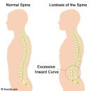 2. Lordosis 이미지