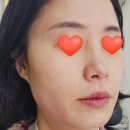 창원 피부과 고주파 레이저 장비 세르프 시술 전후비교 및 솔직 후기