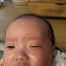 푸른세상안과의원 | 푸른세상안과의원 - 신생아 다래끼 치료