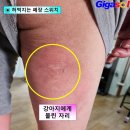 60년 전 강아지한테 물린 상처도 뚫어버리는~폐장 이미지