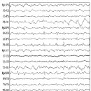 뇌전도(뇌파) 읽는 법- How to Read an EEG 이미지