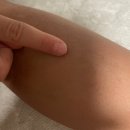 에스씨스테이 | 흉터관리 흉터연고 더마에스씨겔