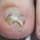 레푸스 화정점 이미지