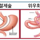 Re:Re:Re:Re: gastric bypass수술후 비타민 B9,12, 구리결핍으로 인한 시신경 질환 이미지