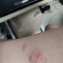 김호철내과의원 | 왼쪽 팔뚝에 온 대상포진 증상 및 후기