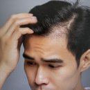 연세모벨르의원 | 일산헤어라인 각지고 넓은 이마 고르고 둥근 헤어라인으로